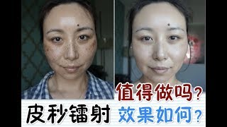 PicoSure Laser Review  BeforeampAfter皮秒镭射体验＋前后对比MsLindaY [upl. by Wise]