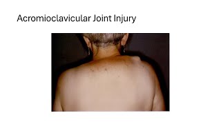 Acromioclavicular Joint Injury [upl. by Foy]