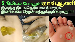 5 நிமிஷம் போதும்கால்ஆணி காணாம போகும் இனிவரவே வராதுkaal aani Tamil foot corn remedy Tamil [upl. by Kinsman]