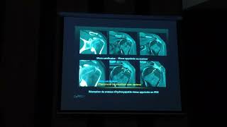 Imagerie  Diagnostic radiologique dune lésion de la coiffe [upl. by Margarethe697]