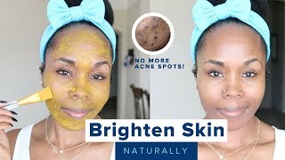 How to Brighten Skin Reduce Acne Scars Hyperpigmentation amp Discoloration  Home Remedies [upl. by Lina]