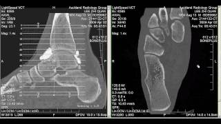 CT Arthrogram of my Ankle 2 April 2009 [upl. by Ahsilra]