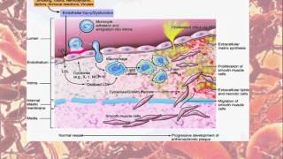 fisiopatología de la aterosclerosis [upl. by Gies]