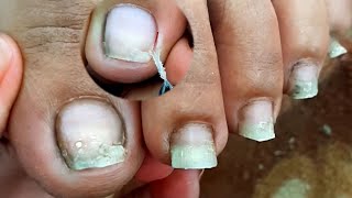 Satisfying Ingrown Toenail Removal  Dry Skin  Pedicure 116 [upl. by Ephraim]