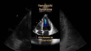 Apical Hypertrophic Cardiomyopathy HCM or Yamaguchi syndrome echocardiography [upl. by Luanni]