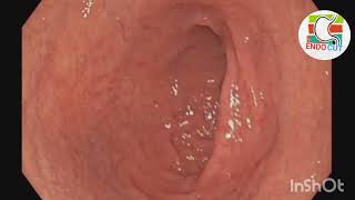 Candida oesophagitis l l Endo Cut [upl. by Ahcirt312]