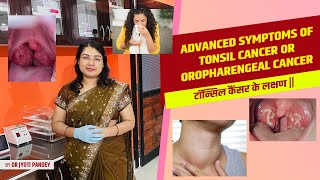 टॉन्सिल कैंसर के लक्षण  Advanced symptoms of TONSIL CANCER or OROPHARENGEAL CANCER [upl. by Carmela]