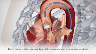 Cardiac Catheterization  Patient Treatment [upl. by Reisinger663]