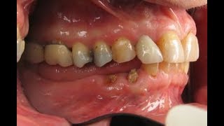 Remedy for Toothache  Kill Tooth Pain Nerve In 3 Seconds Permanently With This Tooth ache remedy [upl. by Daphie101]