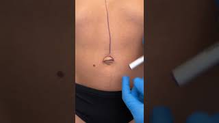 Fixing an Umbilical Hernia [upl. by Philcox268]