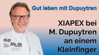 Anwendung von XIAPEX bei Dupuytren Kontraktur am Kleinfinger [upl. by Ennovart]