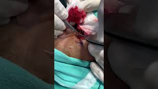 Flap surgery for basal cell carcinoma drlamoriaskincare [upl. by Aihsik]