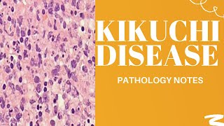 KIKUCHI DISEASESUBACUTE OR HISTIOCYTIC NECROTIZING LYMPHADENITIS  REVISION NOTES ON KIKUCHI [upl. by Nomrej491]