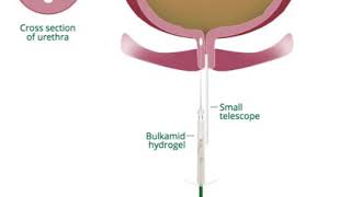 Bulkamid Uretral Bulking [upl. by Coyle]