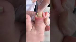 Ingrown toenail removal with Pedicure Knife Cut it easily Ep40 [upl. by Anelhtac]