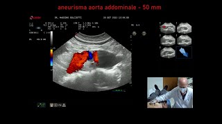 aneurisma dellaorta addominale [upl. by Araihc]