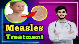 How to treat Measles quickly  Measles Treatment step by step [upl. by Delmer]