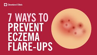 7 Ways to Prevent Eczema FlareUps [upl. by Thomajan]