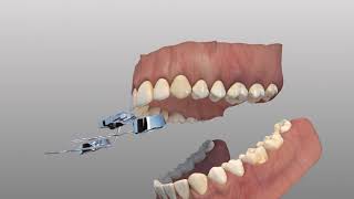 Rapid Palatal Expander [upl. by Earahs496]