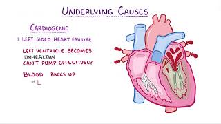 Pulmonary Edema causes symptoms diagnosis treatment pathology [upl. by Neliac]