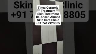 Tinea Corporis Treatment Skin Treatment Dr Ahsan Ahmad Skin Care Clinic91 7417928805 [upl. by Tymon407]