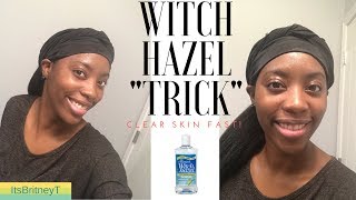 Witch Hazel 7 DAYS for Acne amp Dark spots❤️ [upl. by Gahl]