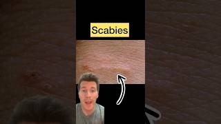 Doctor explains SCABIES in 60 seconds  causes symptoms treatment shorts scabies health [upl. by Emilee]