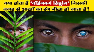 क्या होता है Waardenburg syndrome जिसकी वजह से आखों का रंग नीला हो जाता है [upl. by Eibrab]