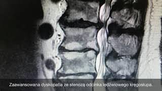 Dyskopatia i przepuklina krążka jak wyglądają na rezonansie magnetycznym [upl. by Loesceke]