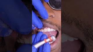 How Tooth Shaving Works [upl. by Innoc]