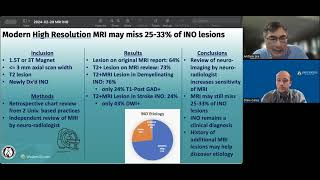 Internuclear Ophthalmoplegia INO on MRI [upl. by Bencion]