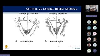 Indications Neurogenic Claudication amp Lateral Recess Stenosis  Phil Fagan MD [upl. by Relyc]