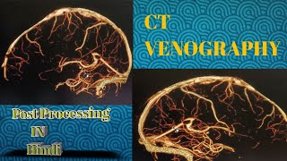 CT Venography Post Processing in Hindi ‎gehealthcare ​⁠ [upl. by Otipaga]