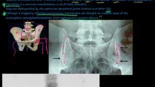 96P Introduction to the Seronegative Spondyloarthropathies [upl. by Rebna]