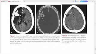 BRAIN IMAGING WITH MRI AND CT [upl. by Giesser]