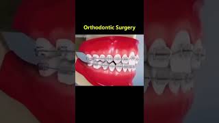 Ortho Treatment open bite العلاج التقويم للعظه المفتوحه 🎖️👌 [upl. by Anaoj]