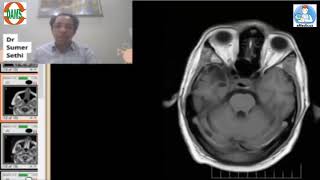 Gliosisencephalomacia by Dr Sumer Sethi [upl. by Anoik]