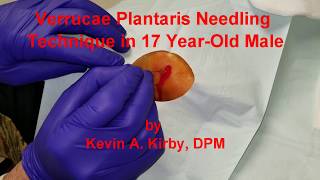 Verrucae Plantaris Needling Procedure Technique [upl. by Silva8]