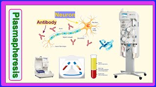 plasmapheresis [upl. by Intyre]