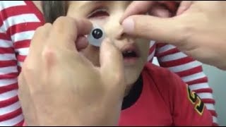 NIÑO QUE SUFRIÓ ACCIDENTE PUEDE VERSE SU OJO COMPLETO GRACIAS A UNA PRÓTESIS [upl. by Aeuhsoj588]