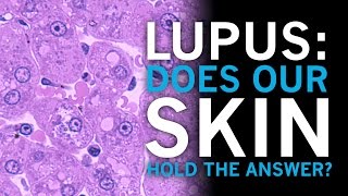 Lupus  Does our skin hold the answer [upl. by Sallad]