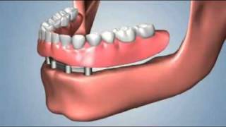 edentulismo completo opciones fija total sobredentaduraflv [upl. by Elwina]