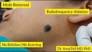 Layer by Layer Mole Removal  No Stitches  No Scars  Dr Anuj Pall MD PhD [upl. by Ocihc]