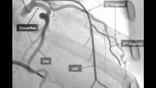 Coronary Dissection [upl. by Nomzaj]