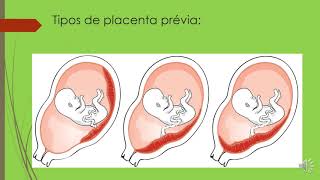 Urgência em Obstetrícia placenta prévia emergenciaobstetrica [upl. by Lomax]