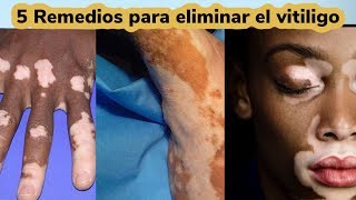 5 Remedios para eliminar el Vitiligo [upl. by Blondy514]