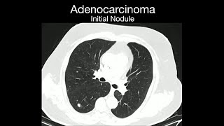 Recurrent Adenocarcinoma [upl. by Kalindi]