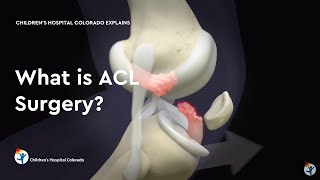 What is ACL Surgery [upl. by Coster]