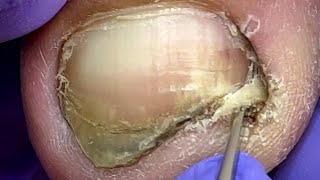 Very dirty nails bacteria infected onychomycosis【Doctor Liu Pedicure】 [upl. by Eicarg374]