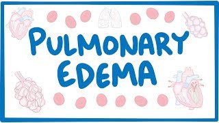 Pulmonary Edema  causes symptoms diagnosis treatment pathology [upl. by Emmey]